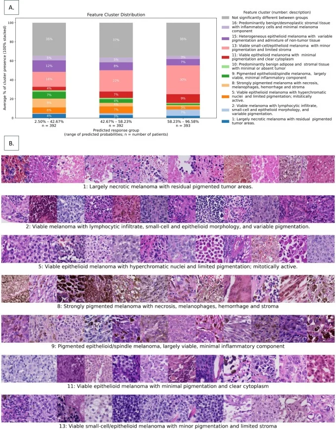 advanced melanoma