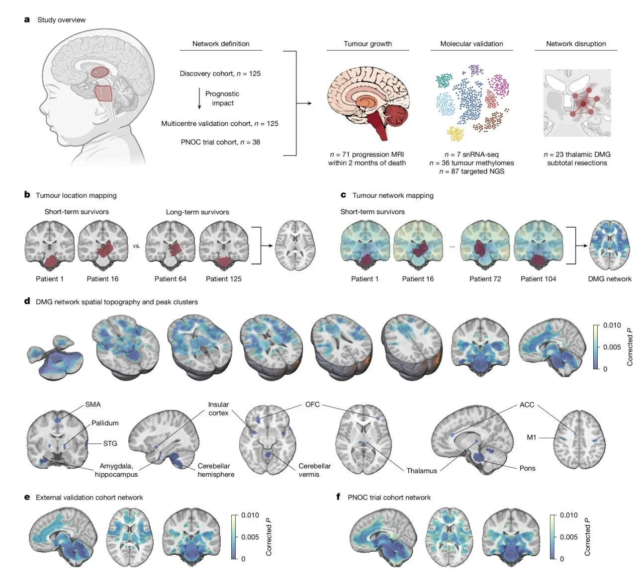 George Kumar: Tumour Network Mapping Reveals a Hidden Circuit Driving Diffuse Midline Glioma 2 George Kumar: Tumour Network Mapping Reveals a Hidden Circuit Driving Diffuse Midline Glioma