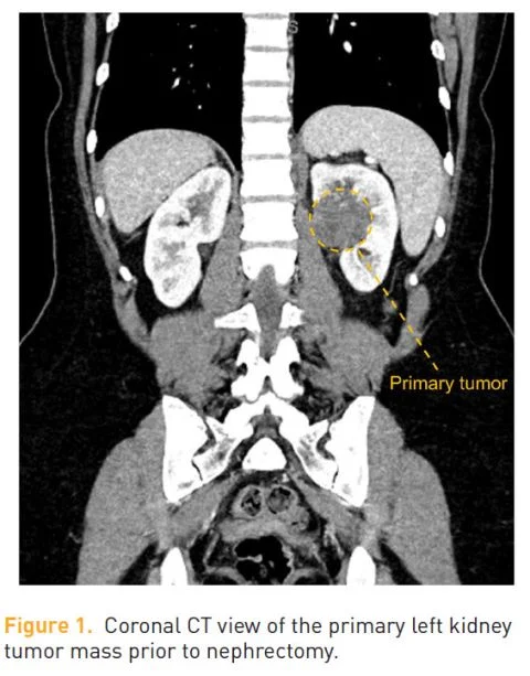 Pavlos Msaouel: Tumor Plasticity and Molecular Pathology in FH-Deficient RCC