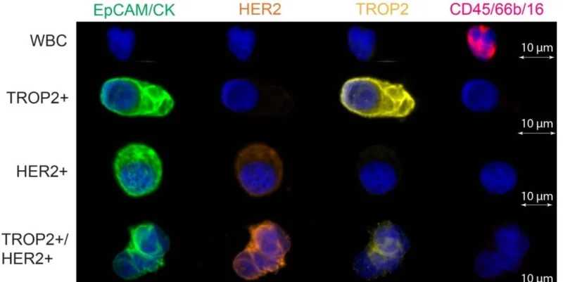 Avanish Mishra: New Insights Into ADC Resistance in Metastatic Breast Cancer 2 Avanish Mishra: New Insights Into ADC Resistance in Metastatic Breast Cancer
