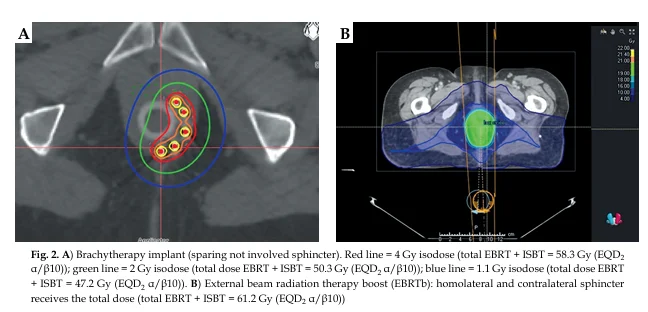 Does Boost Technique Matter in Chemoradiotherapy? – Journal of Contemporary Brachytherapy