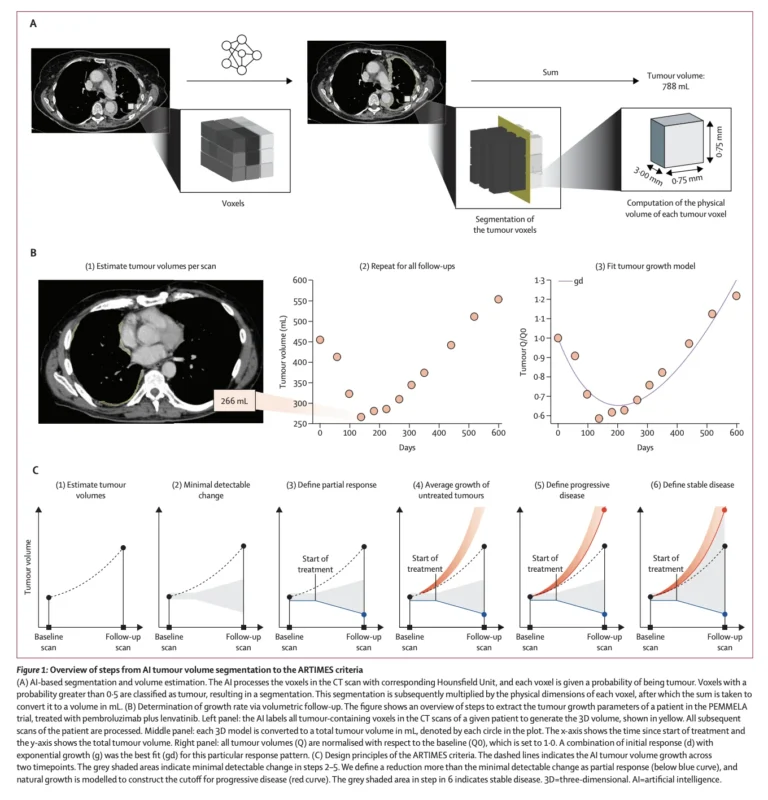 ARTIMES AI Volumetry May Improve Response Assessment in Pleural Mesothelioma 2 ARTIMES AI Volumetry May Improve Response Assessment in Pleural Mesothelioma