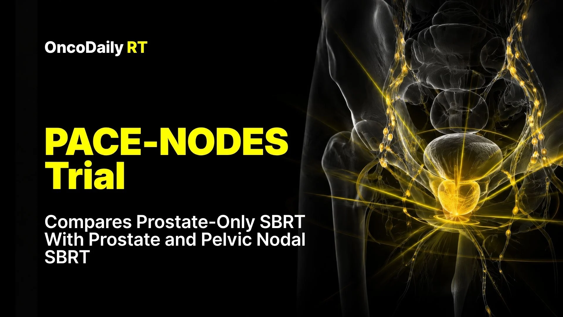 PACE-NODES Trial Compares Prostate-Only SBRT With Prostate and Pelvic Nodal SBRT