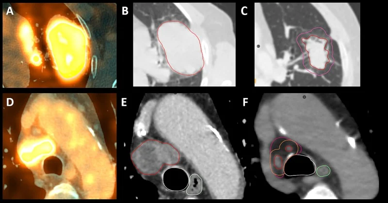 ESTRO-EORTC Expert Guideline on Target Delineation and Radiotherapy for Stage I–III Small Cell Lung Cancer