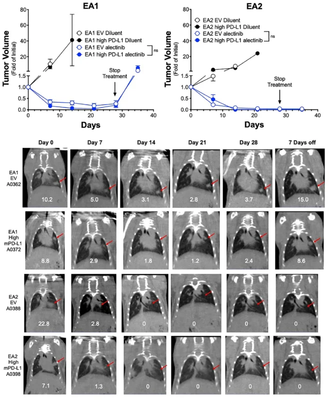 High PD-L1 Expression Linked To Shorter PFS With First-Line ALK TKIs In ALK-Rearranged NSCLC 5 High PD-L1