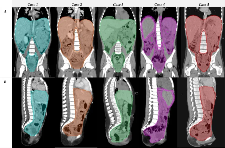 Consensus Guidelines from EpSSG and QUARTET for Delineating Highly Conformal Whole Abdominopelvic Radiotherapy 2 Consensus Guidelines from EpSSG and QUARTET for Delineating Highly Conformal Whole Abdominopelvic Radiotherapy
