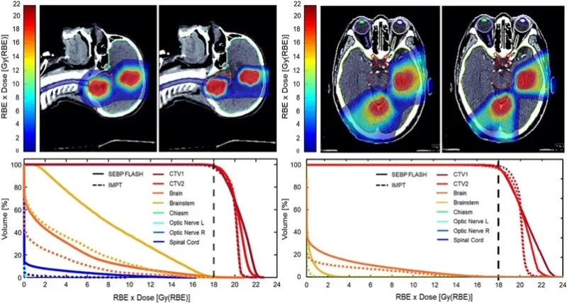 FLASH SRS With Proton Bragg Peak Tracking Achieves IMPT Equivalent Brain Metastasis Dosimetry 2 FLASH SRS With Proton Bragg Peak Tracking Achieves IMPT Equivalent Brain Metastasis Dosimetry