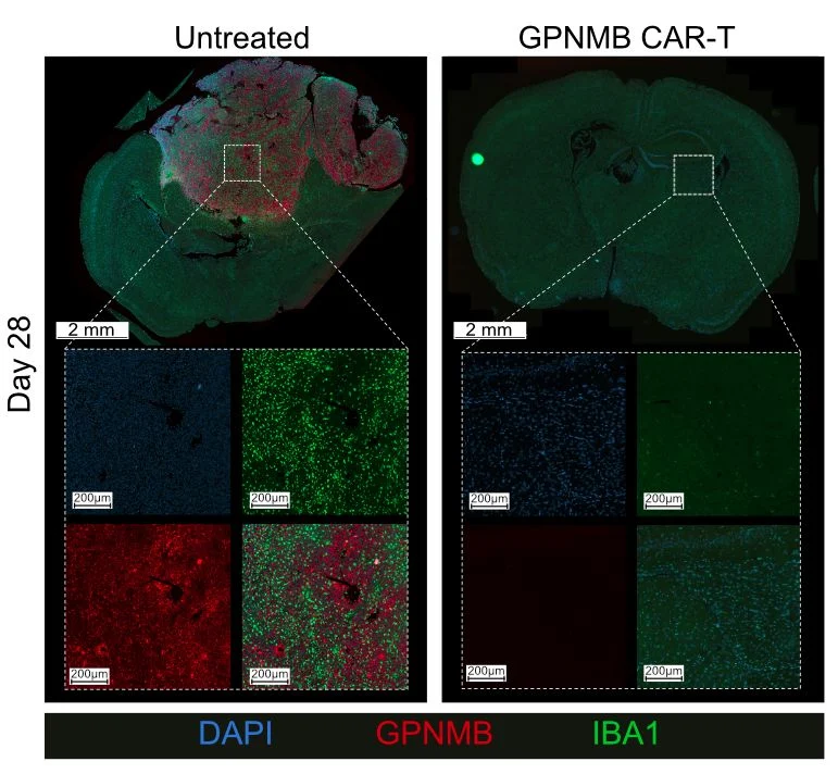 Sheila Singh: A Novel CAR‑T Strategy for Glioblastoma 2 Sheila Singh: A Novel CAR‑T Strategy for Glioblastoma