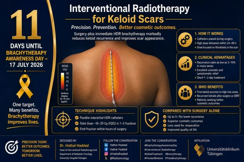 Hathal Haddad: The Role of Brachytherapy in Preventing Keloid Recurrence 2 Hathal Haddad