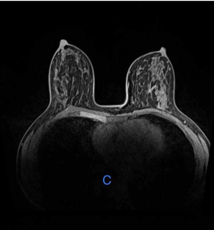 Kefah Mokbel: Preoperative MRI in DCIS - No Survival Benefit at 15 Years 2 Kefah Mokbel: Preoperative MRI in DCIS - No Survival Benefit at 15 Years