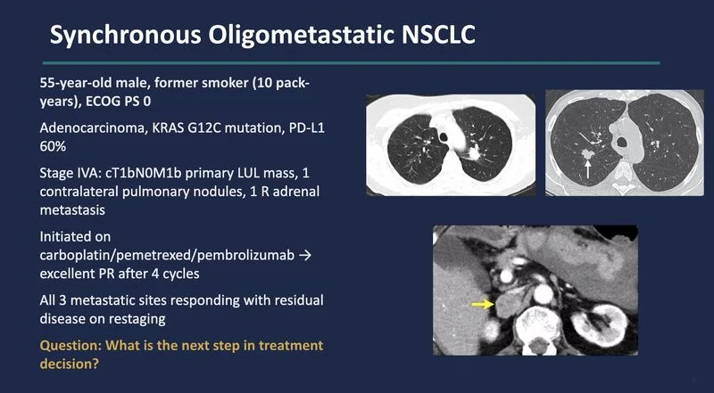 Eric Singhi: Key Advances in Lung Cancer at BTGLung2026 13 Eric Singhi: Key Advances in Lung Cancer at BTGLung2026