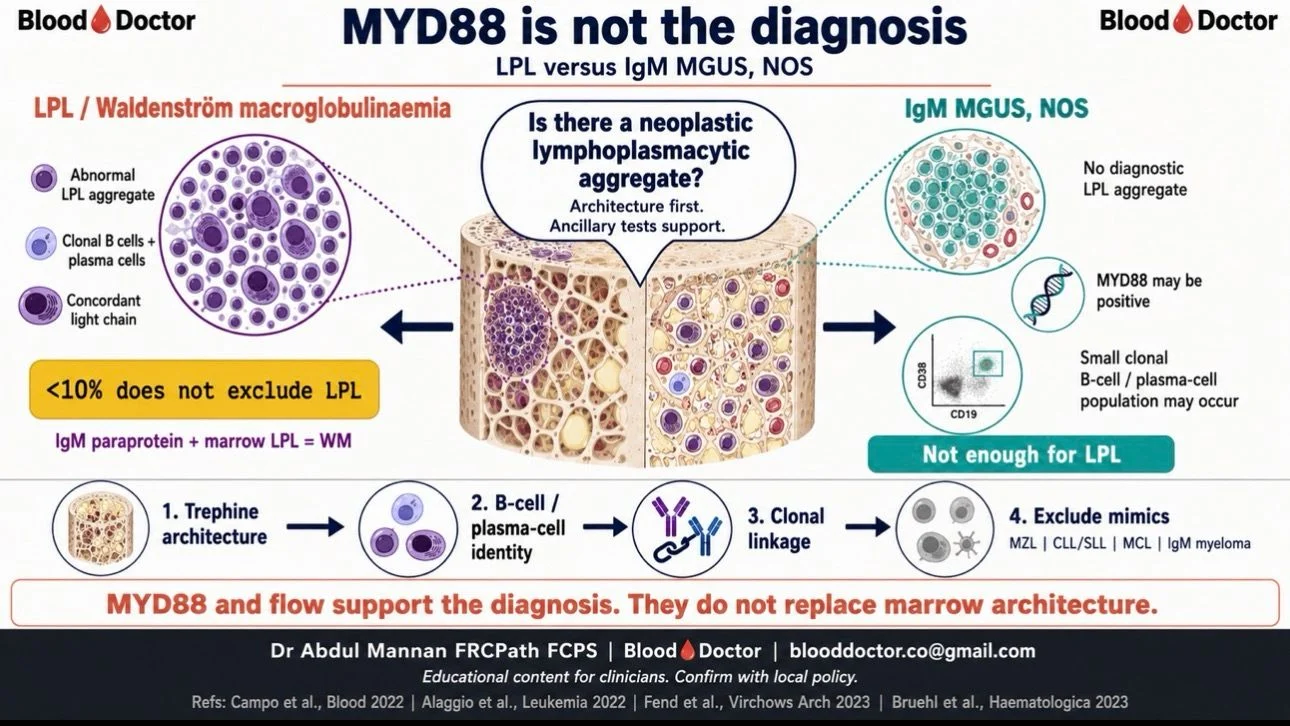 Abdul Mannan: ICC 2022 Criteria For Differentiating IgM MGUS From Low-Volume Lymphoplasmacytic Lymphoma