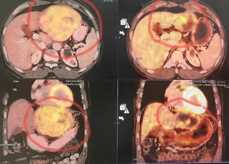 Deepak Gupta: SBRT Plus Immunotherapy Achieves Complete Response in Advanced HCC Case 2 Deepak Gupta