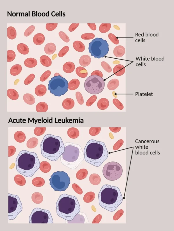 Anthony Letai։ New Study Identifies Protein Pathway That Could Help Prevent Leukemia 2 Anthony Letai