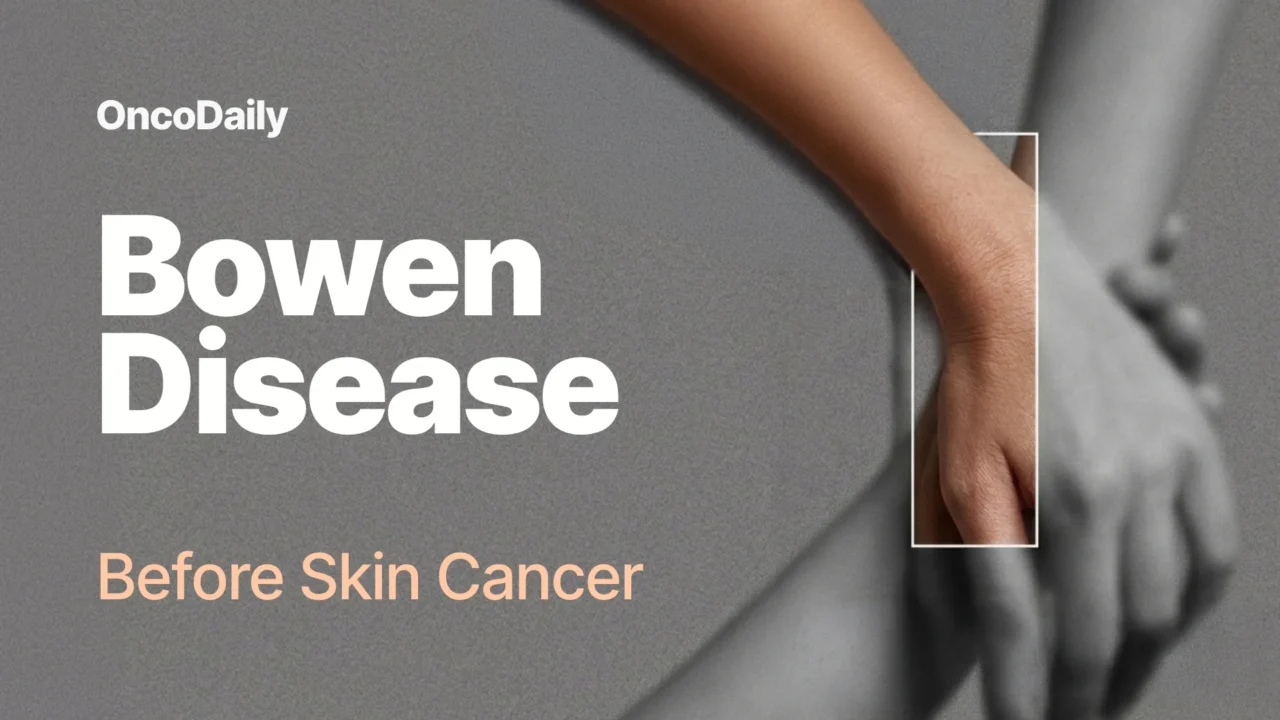 Bowen Disease: Essential Facts About Skin Precancer Symptoms, Causes, Diagnosis, and Treatment