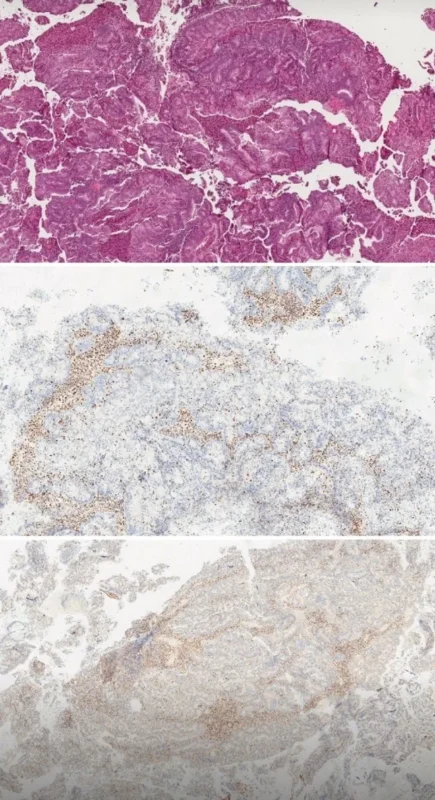 Liang Cheng: Histologic Features Identify MMR Deficiency in Endometrioid Carcinoma