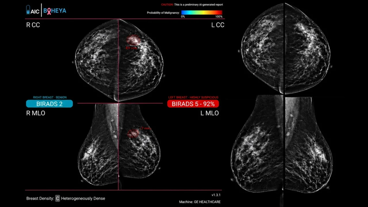 Sahar Mansour։ Population-Specific AI Advances Precision Breast Cancer Detection