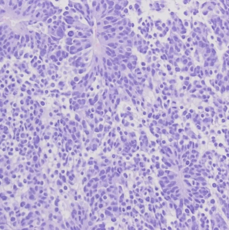 Advancing Treatment Options for Children With Rare RAS-Mutated Cancers - NCI