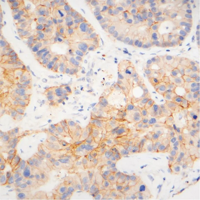 Thor Halfdanarson: TROP2 ADCs as a Potential Therapeutic Pathway for Lung NECs 2 Thor Halfdanarson: TROP2 ADCs as a Potential Therapeutic Pathway for Lung NECs