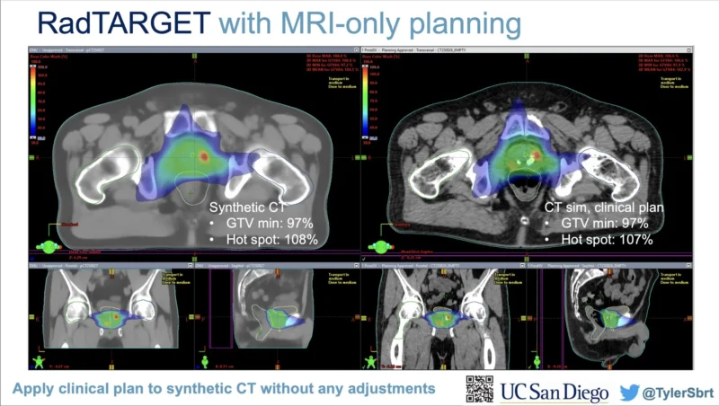 Tyler Seibert Introduces PrecisionPro Fusion for Prostate Radiotherapy Planning 6 Tyler Seibert