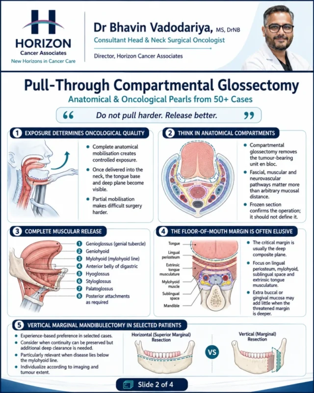 Lessons from 50+ Pull-Through Compartmental Glossectomies - Humans of Oncology 4 Lessons from 50+ Pull-Through Compartmental Glossectomies - Humans of Oncology