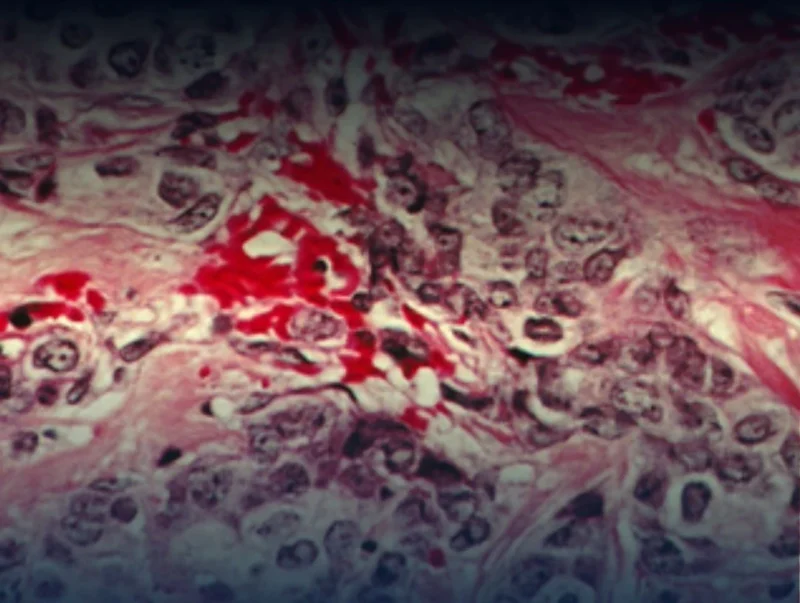 Harpreet Singh: What SERENA-6 Could Mean for the Future of ESR1-Mutated Breast Cancer 2 Harpreet Singh