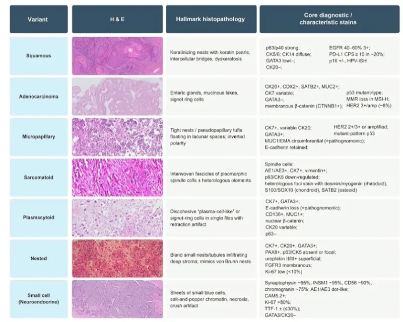 Enrique Grande: Histological Subtypes Reveal the Biological Complexity of Urothelial Carcinoma 2 Enrique Grande