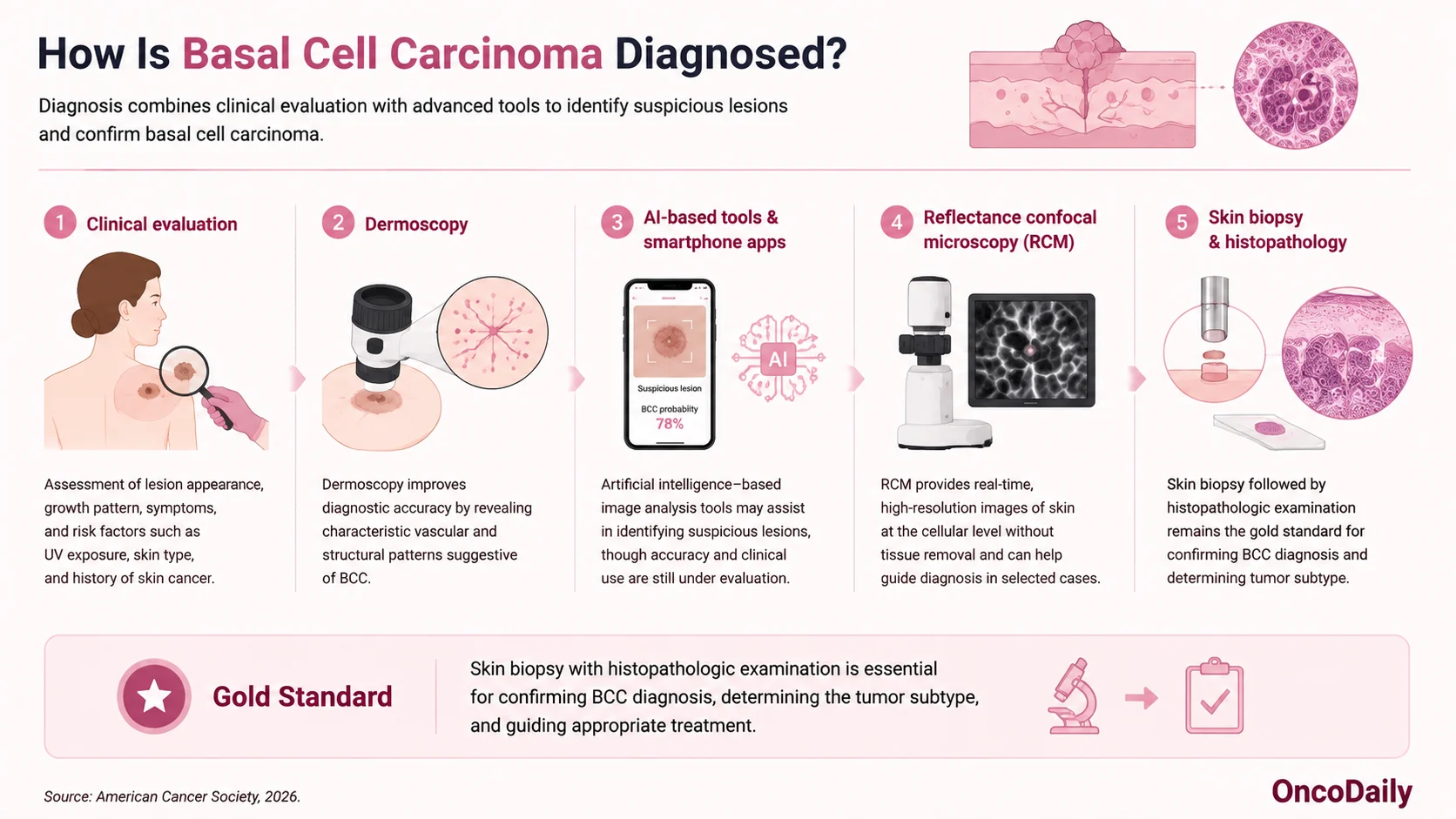 Basal Cell Carcinoma (BCC): Symptoms, Causes, Diagnosis and Treatment