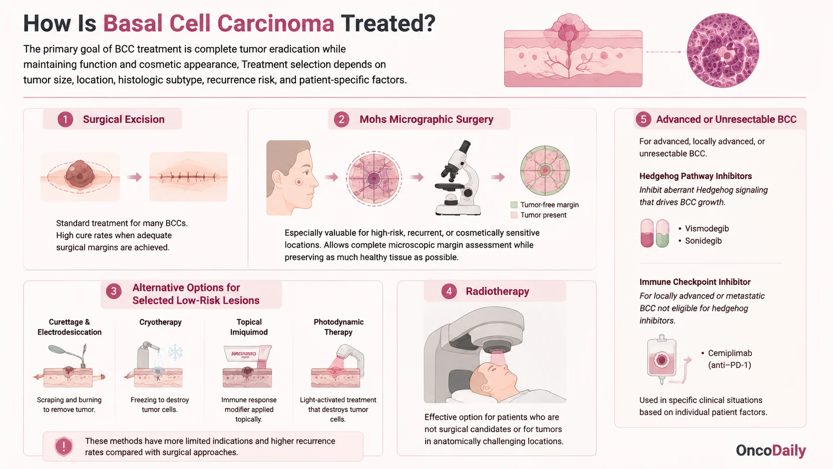 Basal Cell Carcinoma (BCC): Symptoms, Causes, Diagnosis and Treatment