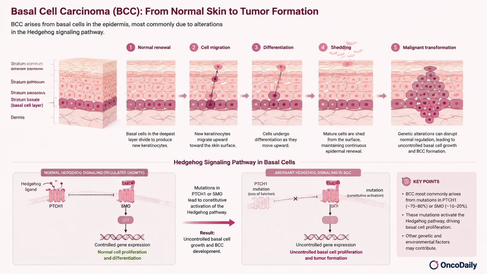 Basal Cell Carcinoma (BCC): Symptoms, Causes, Diagnosis and Treatment