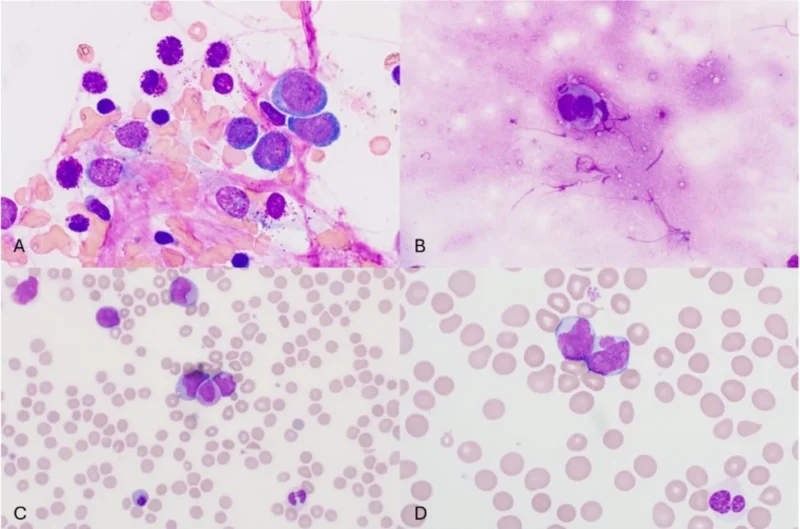 Suggested Articles on Leukemia and Hematopathology Shared by Sanam Loghavi 6 Suggested Articles on Leukemia and Hematopathology Shared by Sanam Loghavi