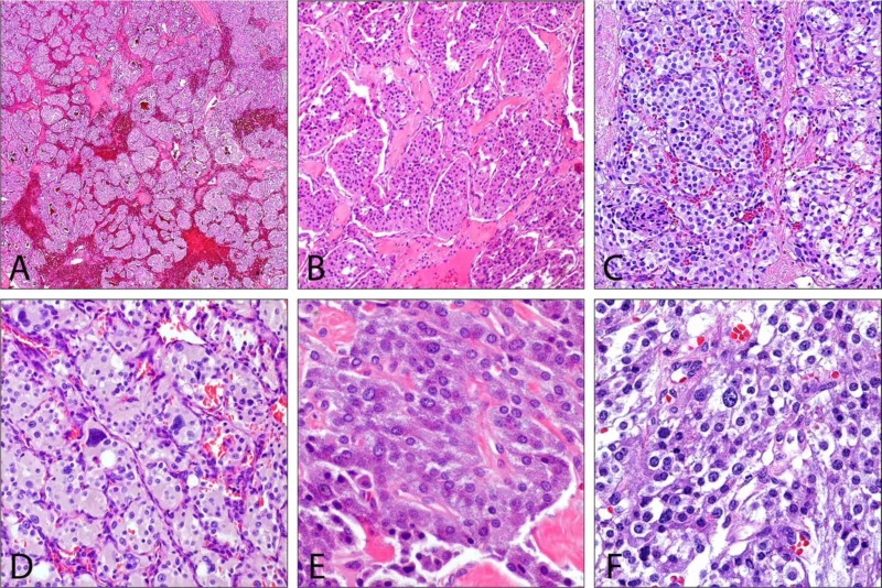 Liang Cheng: What’s New in the Classification of Bladder Neuroendocrine Tumors? 3 Liang Cheng