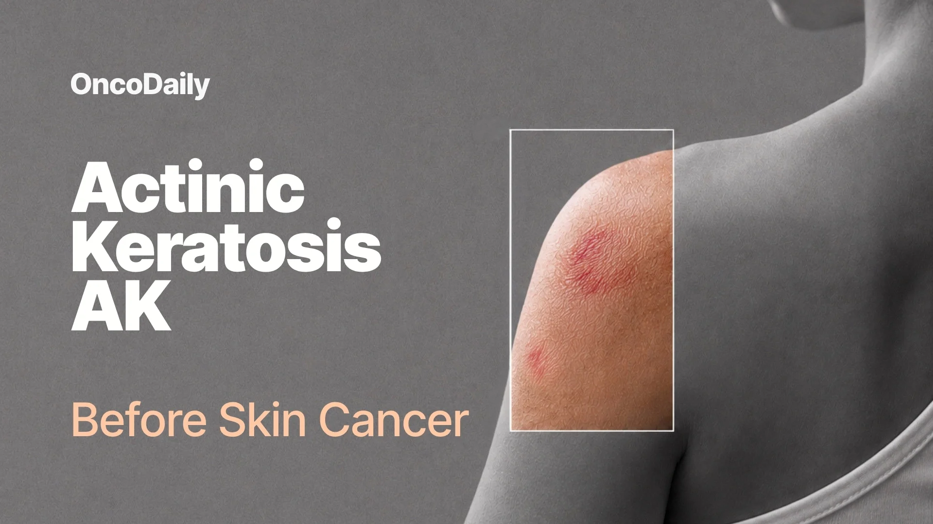 actinic keratosis AK