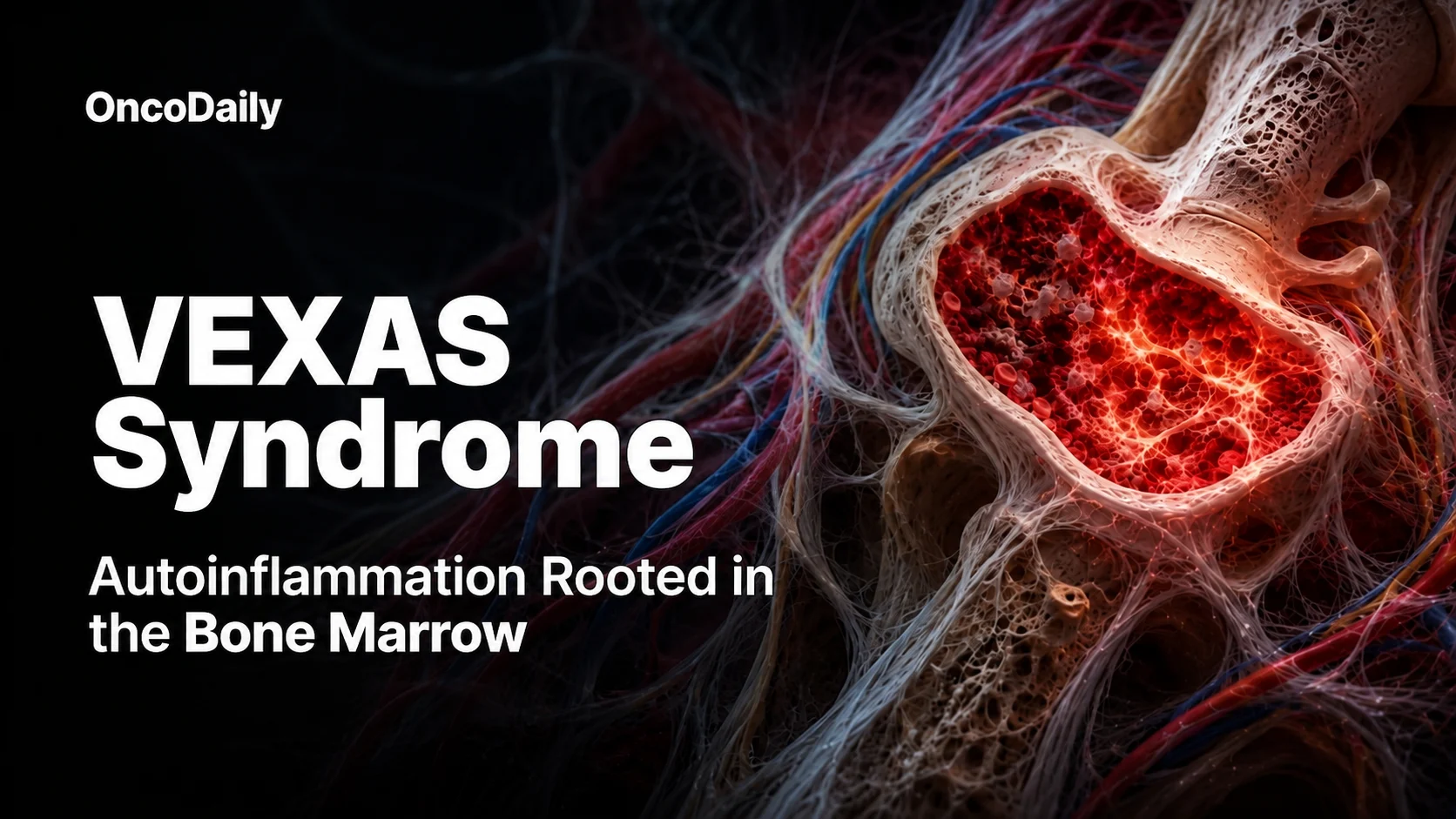 VEXAS Syndrome