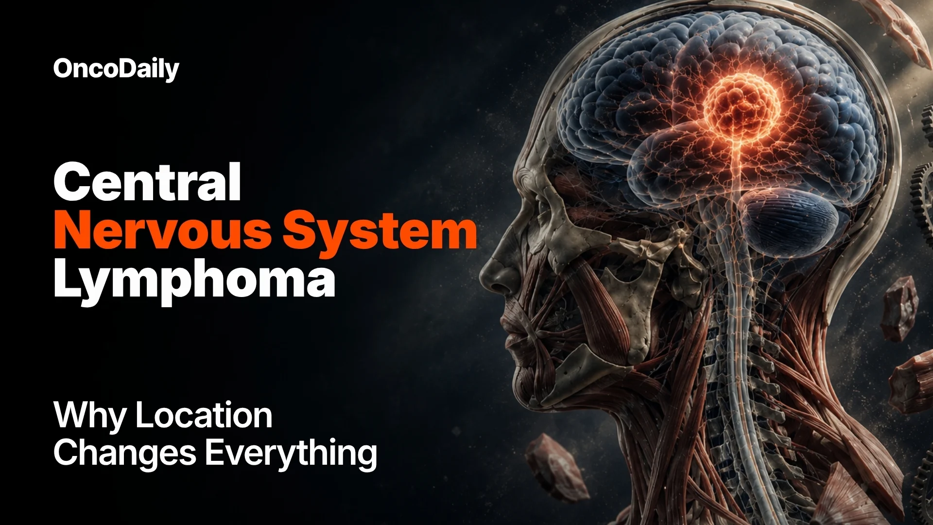 CNS Lymphoma Primary CNS lymphoma (PCNSL)