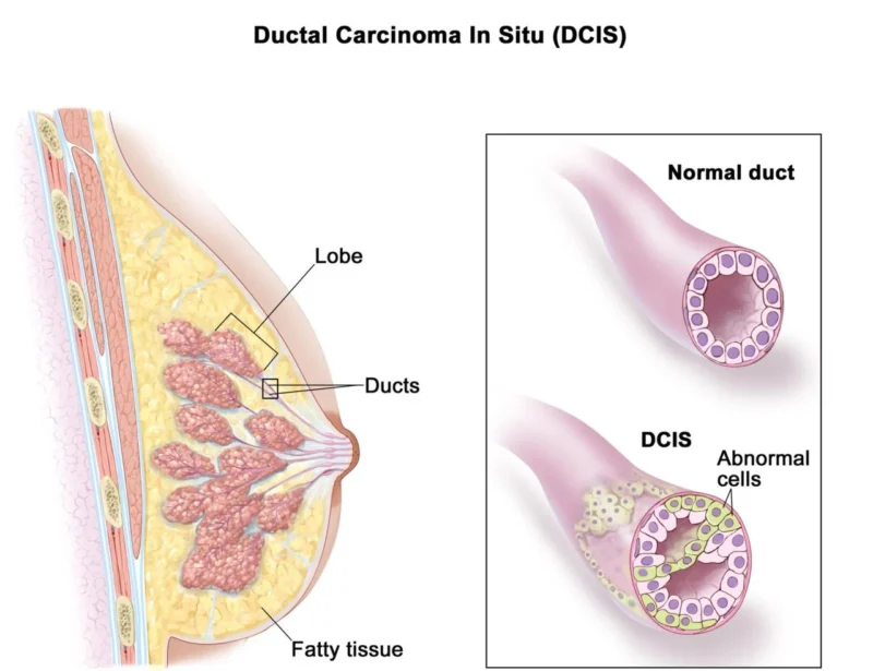 David Wazer: Before We Omit Radiation for Breast DCIS - How Much Should We Trust DCISionRT? 2 David Wazer: Before We Omit Radiation for Breast DCIS - How Much Should We Trust DCISionRT?