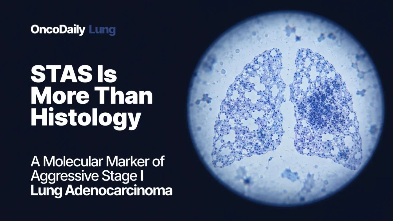STAS in Stage I Lung Adenocarcinoma Is More Than a Histologic Finding: Multi-Omic Profiling Reveals an Aggressive Molecular Phenotype