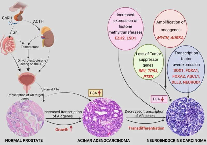 Liang Cheng: Can Molecular Classification Improve Outcomes in Prostatic Neuroendocrine Tumors? 2 Liang Cheng: Can Molecular Classification Improve Outcomes in Prostatic Neuroendocrine Tumors?