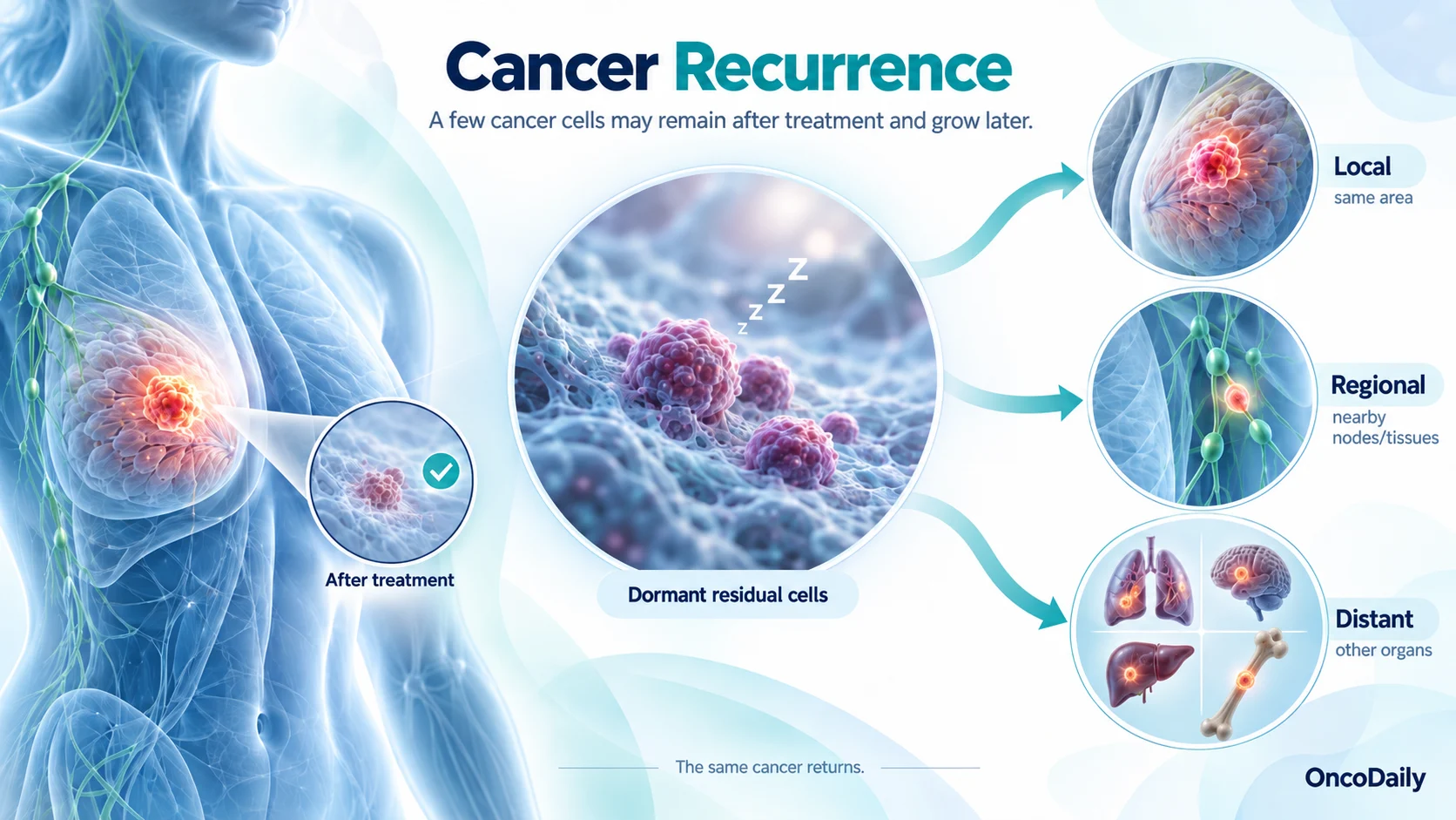 Why Cancer Comes Back: The Biology of Cancer Recurrence and Relapse 5 Why Cancer Comes Back: The Biology of Cancer Recurrence and Relapse