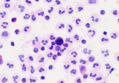 Rare Cells, Big Stories: What Circulating Tumor Cells Can Tell Us About Cancer 2 tethis