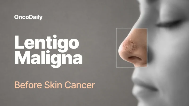 Lentigo Maligna: Warning Signs, Causes, Treatment, and the Importance of Early Detection