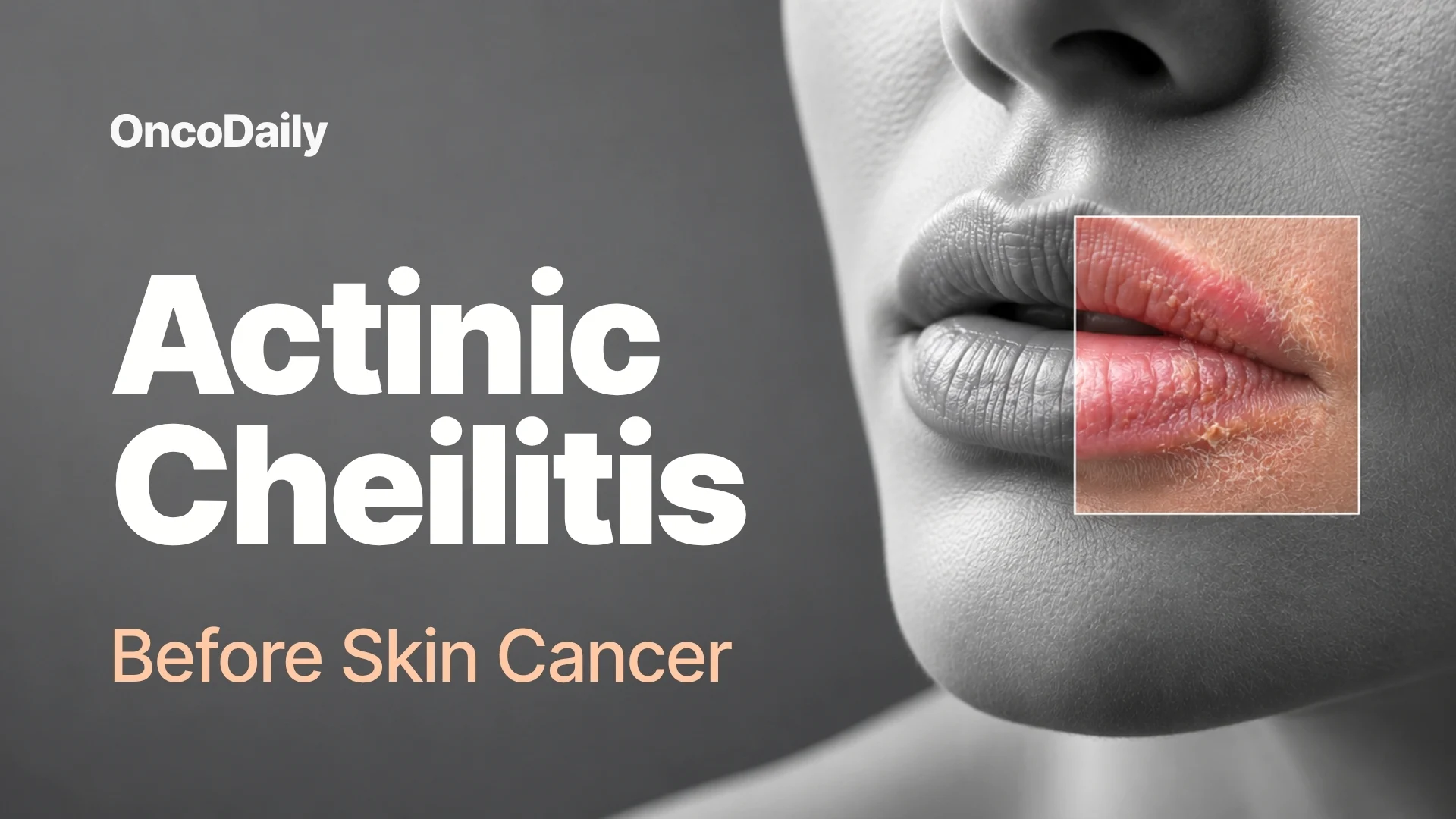 Actinic Cheilitis: The Hidden Sun-Damaged Lip Lesion That Can Become Cancer
