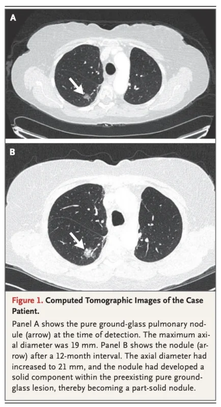 Pulmonary Nodules in 2026: A Risk-Based Approach to Surveillance, Biopsy, and Definitive Treatment 5 Pulmonary Nodules