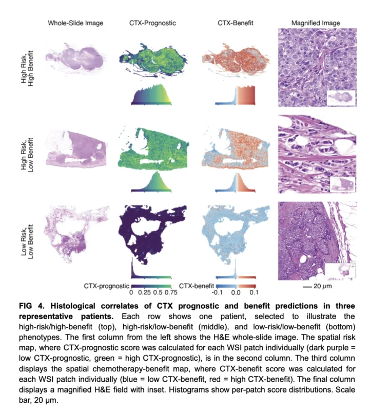 Multi-Modal AI May Refine Adjuvant Escalation in High-Risk HR+/HER2− Early Breast Cancer 4 Multi-Modal AI