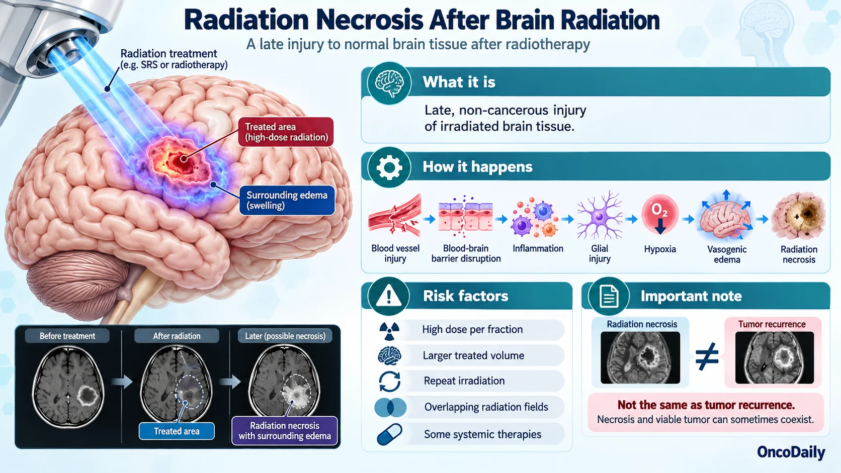 Radiation Necrosis After Brain Radiation: Symptoms, Diagnosis, Treatment, and Recovery
