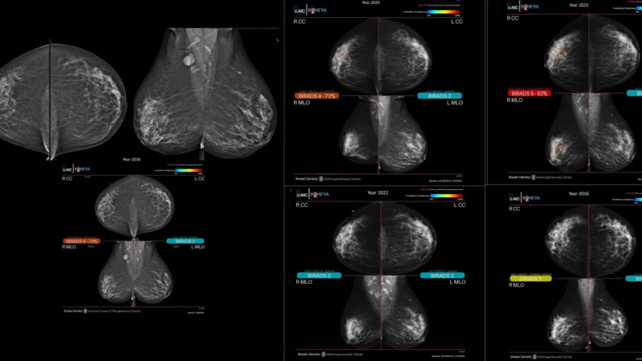 Sahar Mansour: AI’s Role in Detecting Subtle Breast Cancer Changes