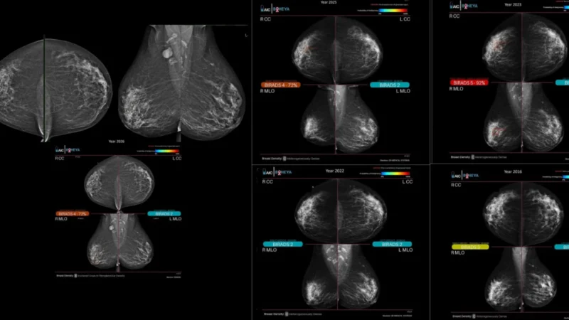 Sahar Mansour: AI’s Role in Detecting Subtle Breast Cancer Changes