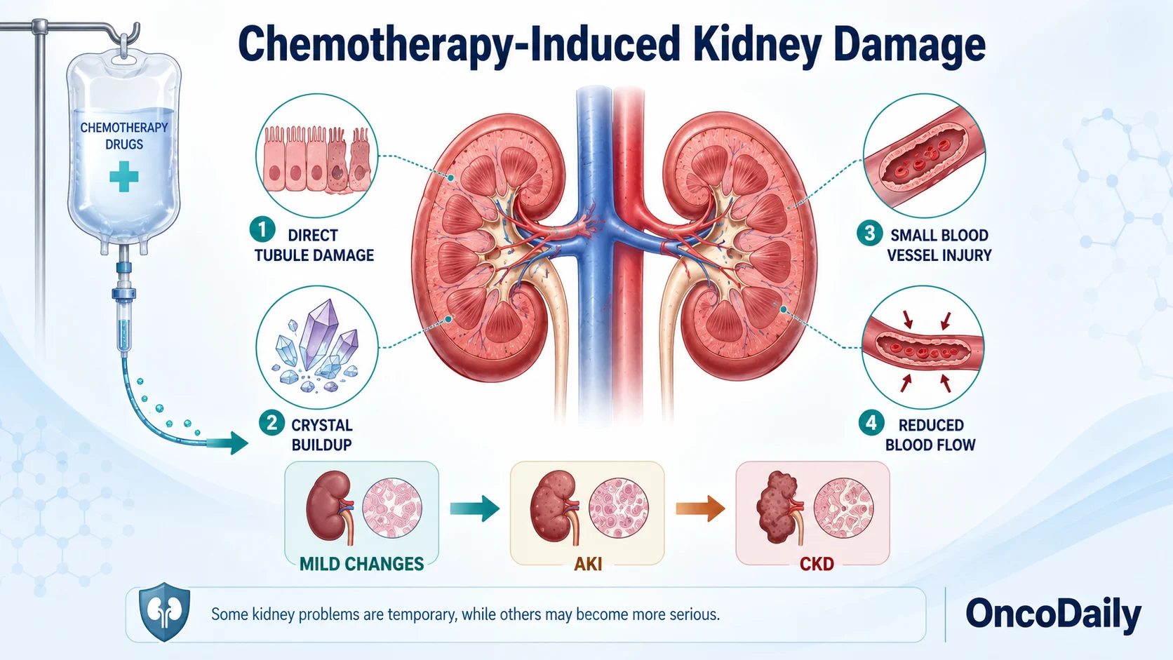 Chemotherapy-Induced Kidney Damage: Symptoms, High-Risk Drugs and Prevention 5 Chemotherapy-Induced Kidney Damage: Symptoms, High-Risk Drugs and Prevention