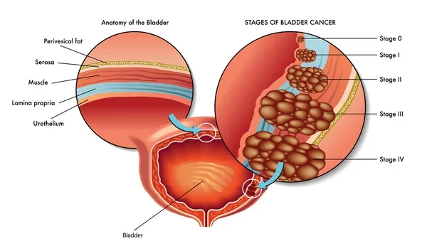 Bladder cancer