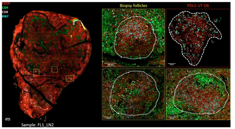 Can 3D Ex Vivo Lymphoma Spheroids Predict Immunotherapy Response? 6 Can 3D Ex Vivo Lymphoma Spheroids Predict Immunotherapy Response?